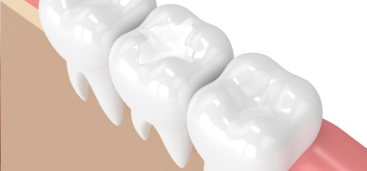 White Fillings