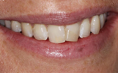 Teeth whitening happy patient smile
