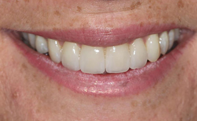 Teeth whitening happy patient smile