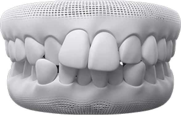 Teeth whitening treatment at Pinner Green Dental