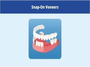  A close-up of a tooth fitted with a denture, representing composite bonding by Pinner Green Dental.