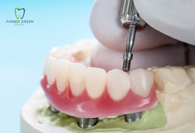 Relieve Pain from Dental Implants