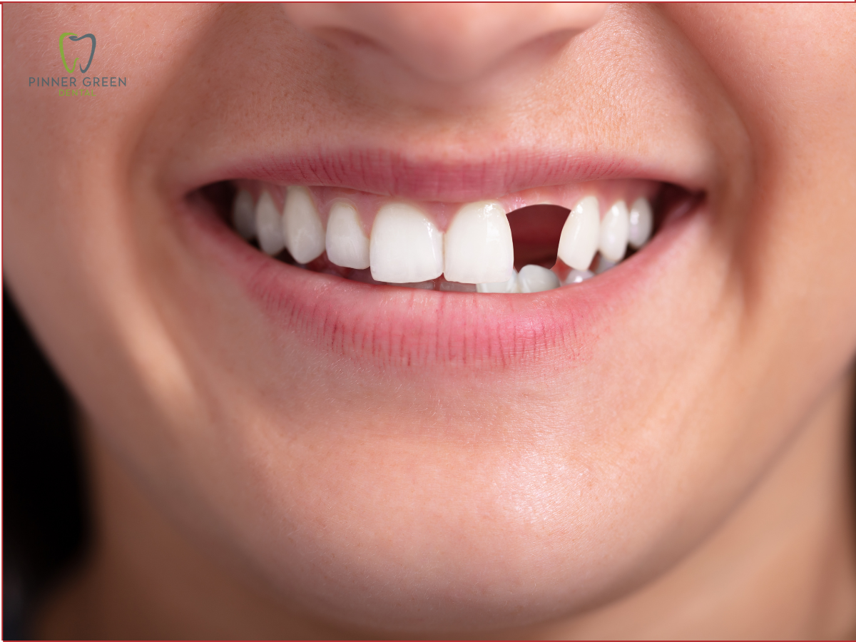 Replace a Missing Tooth