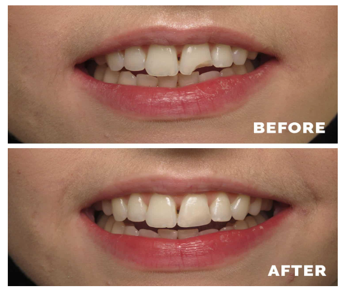 Composite Bonding: The Affordable Way to Fix Chips and Gaps